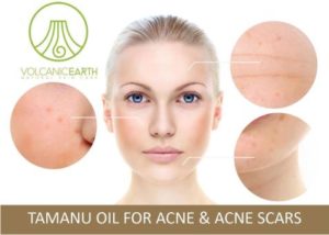 Acne, acne scarring, pimples.