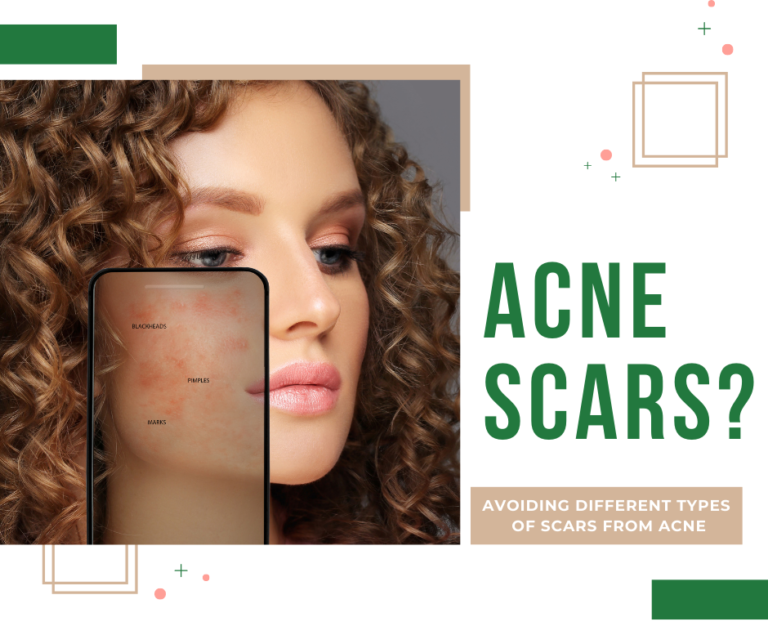 AVOIDING DIFFERENT TYPES OF SCARS FROM ACNE