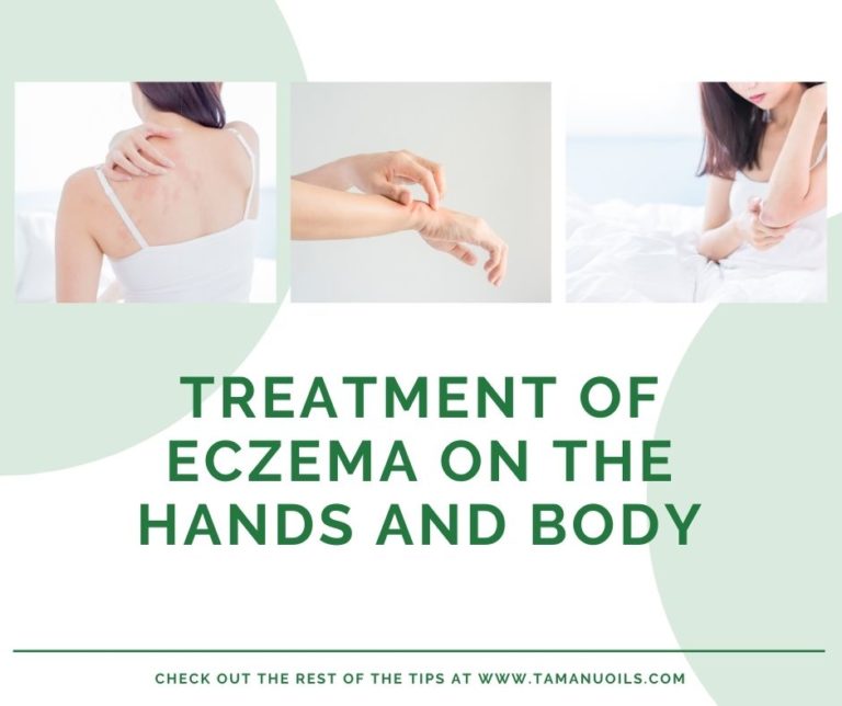 Treatment of Eczema on the Hands and Body